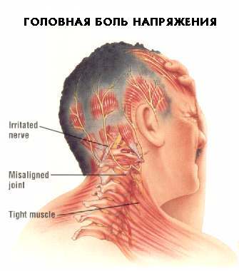 Ученые: Выявлен новый биомаркер мигрени