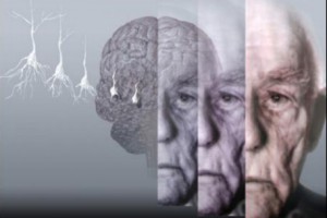 Лекарство, способное замедлить болезнь Альцгеймера, было создано американцами